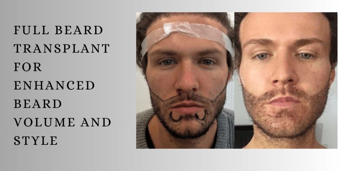 Full Beard Transplant for Enhanced Beard Volume and Style