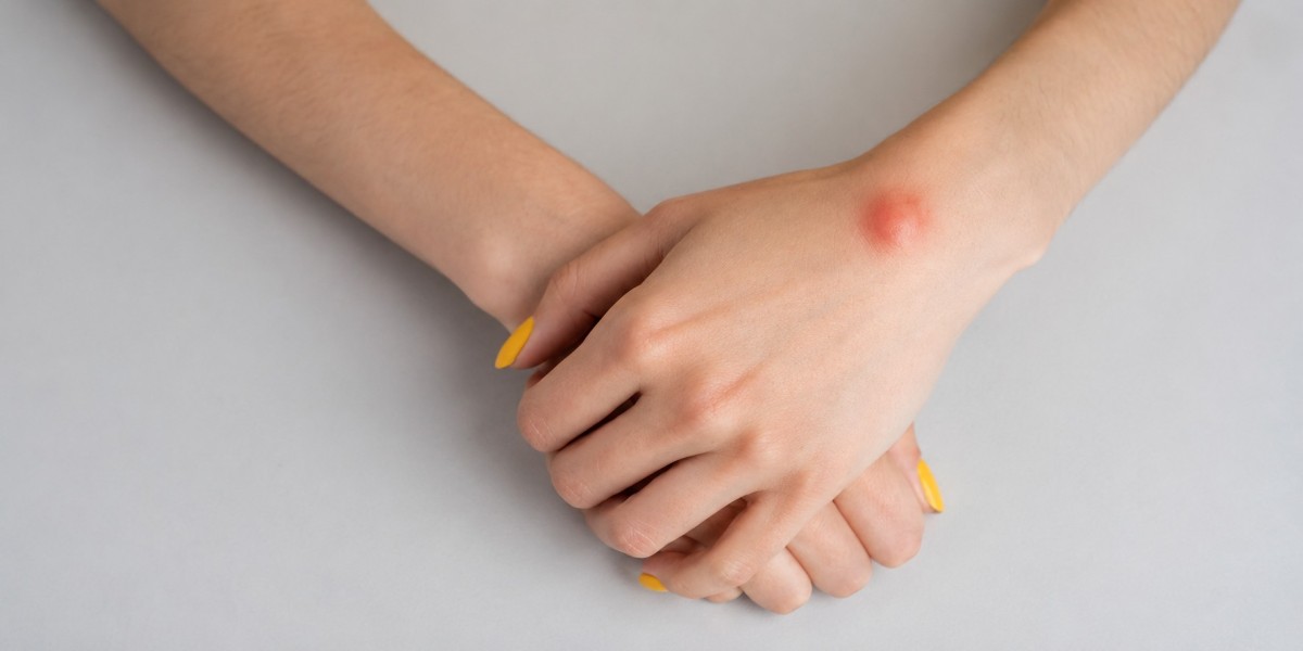 Best Home Remedies For Lipoma And Natural Treatment Tips