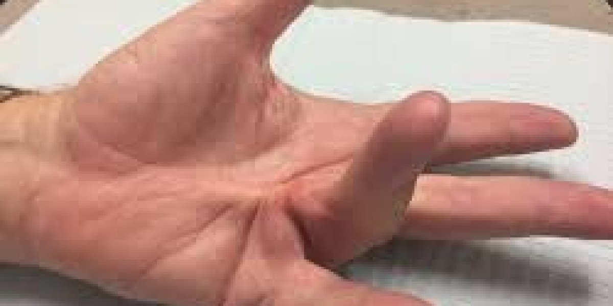 How Dupuytren Contracture New Treatment Can Support Hand Function