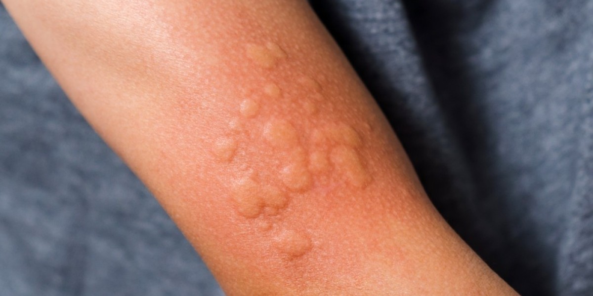 Is It Just a Rash or Cold-Induced Urticaria? Signs You Shouldn't Ignore