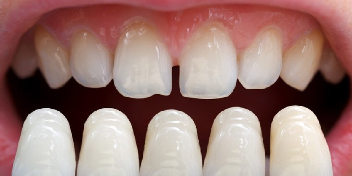 How to Choose the Best Clinic for Veneers Newport Beach in 2026