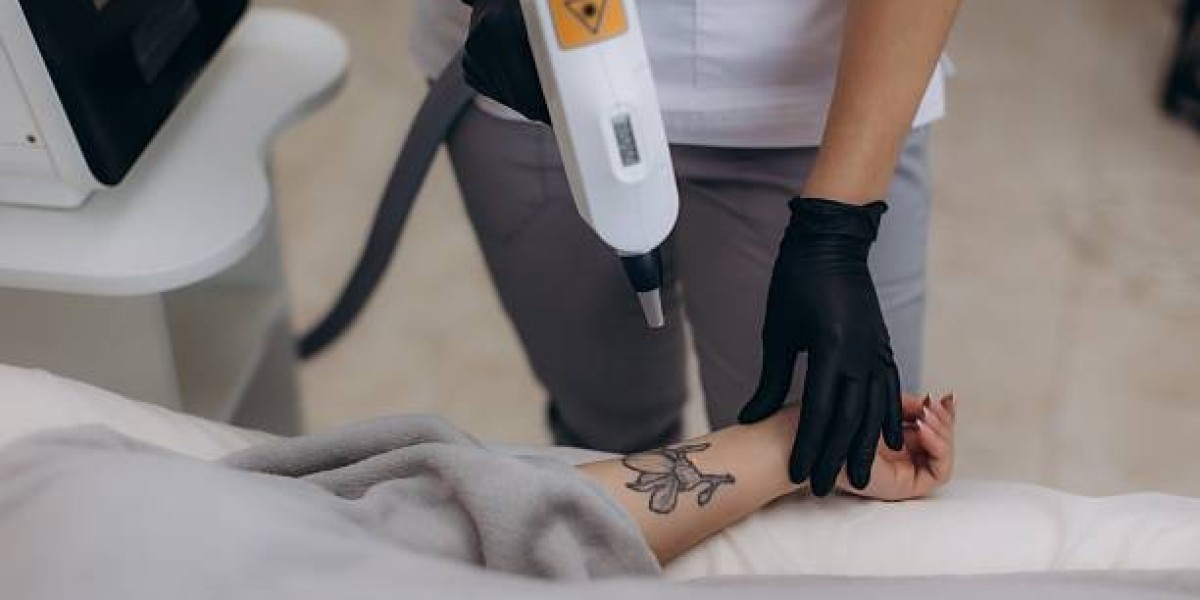 What Is the Most Effective Tattoo Removal Method?