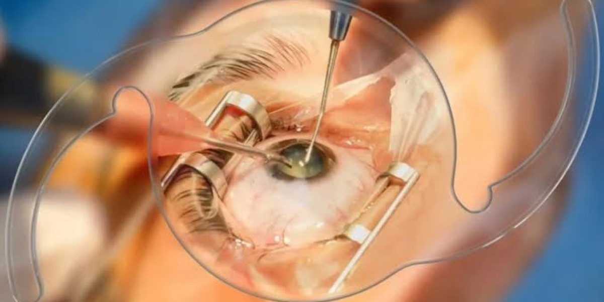 Best Cataract Surgeon in Dubai: Understanding Cataract Surgery